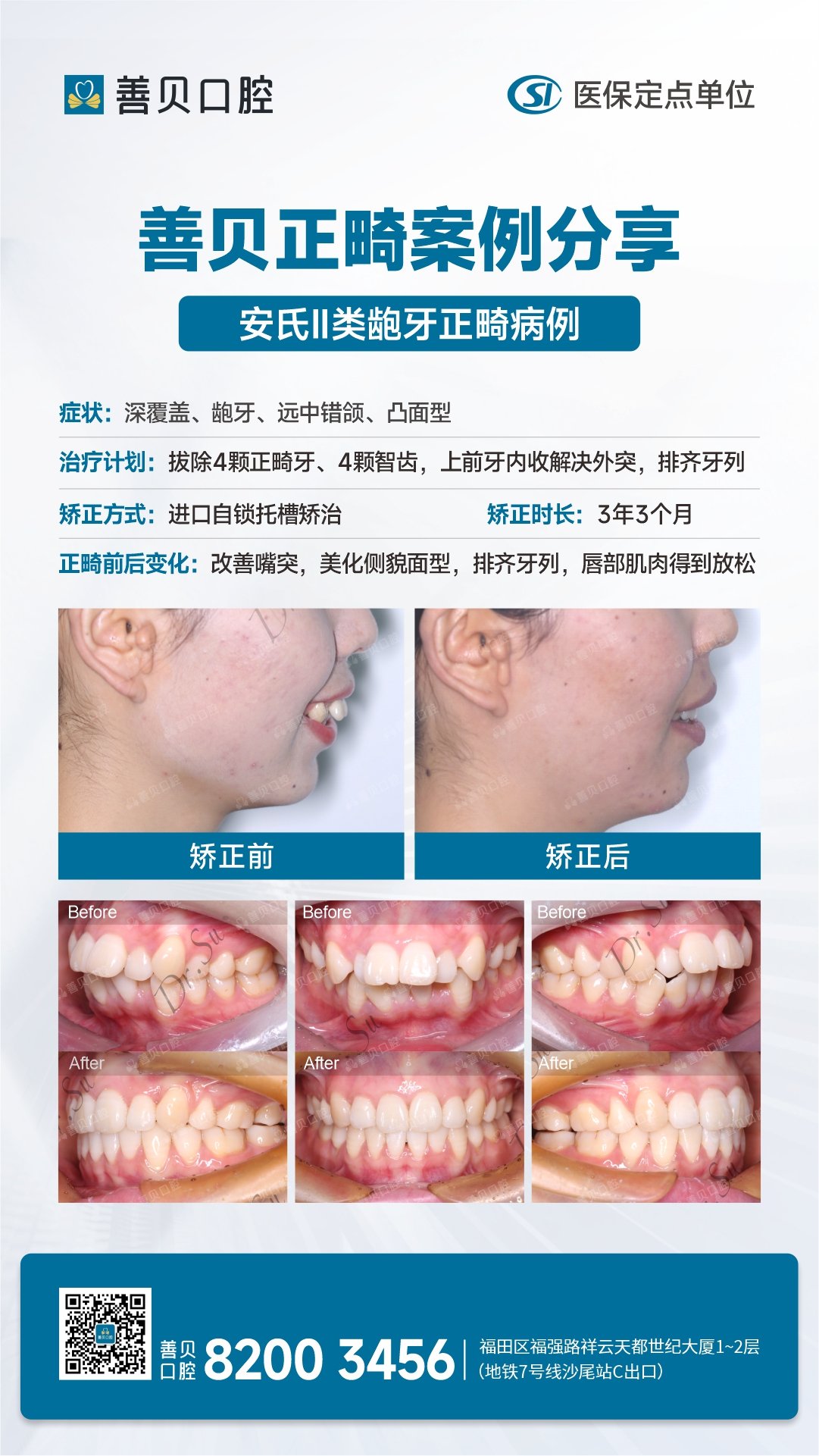 <a href='http://hk.szsbck.com' target='_blank'><u>深圳箍牙</u></a>醫院,深圳牙科口腔推薦