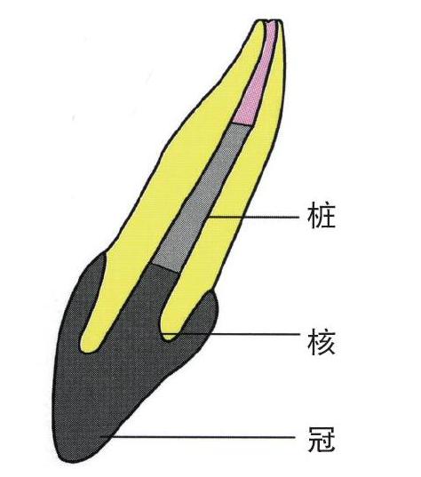 桩核冠-牙齿打桩-维港口腔连锁-深圳根管治疗-维港欢笑口腔-维港欢乐口腔